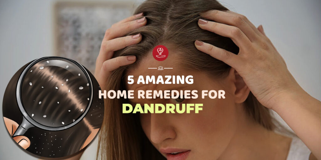 Home Remedies for Dandruff