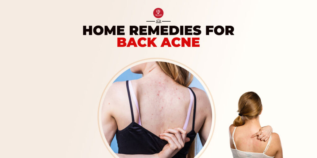 Home Remedies For Back Acne
