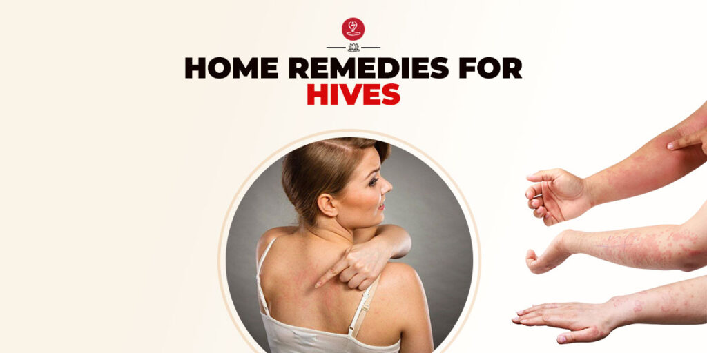 Home Remedies For Hives