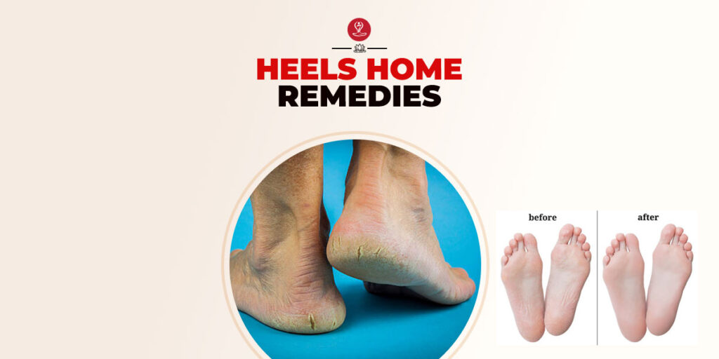 cracked heels home remedies