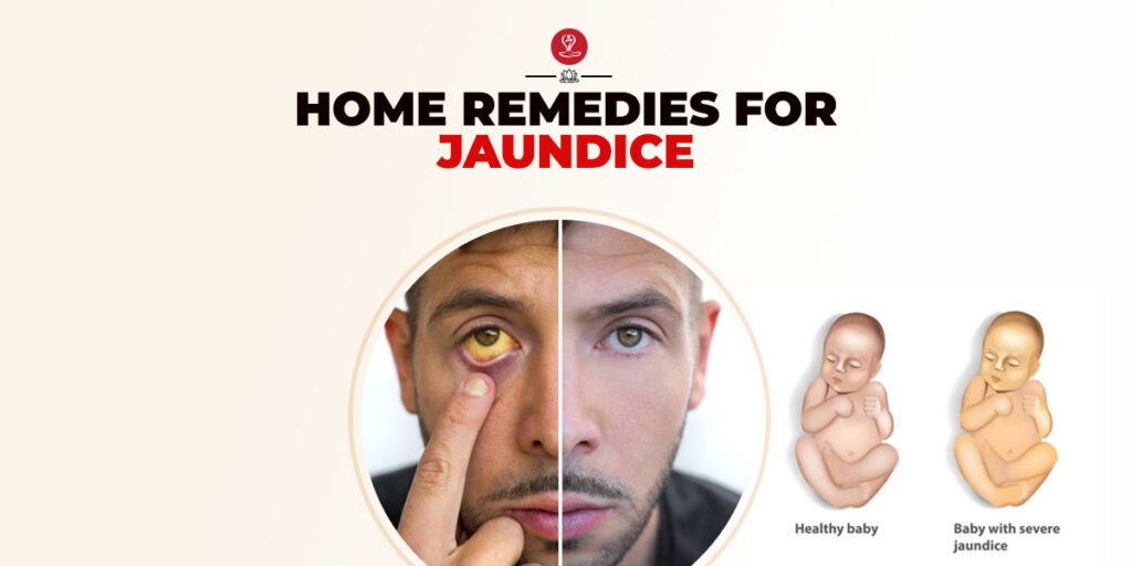 home remedies for jaundice