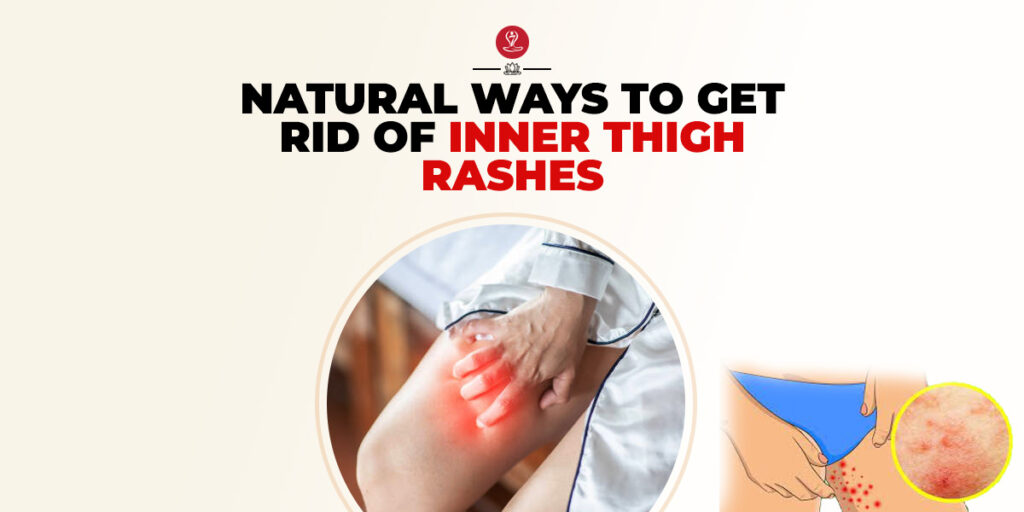 Inner Thigh Rashes