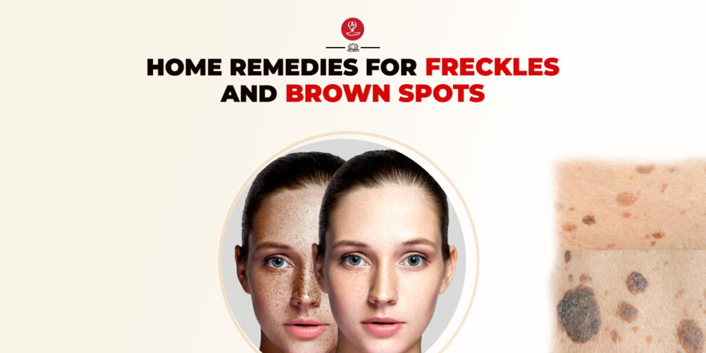 Remedies For Freckles