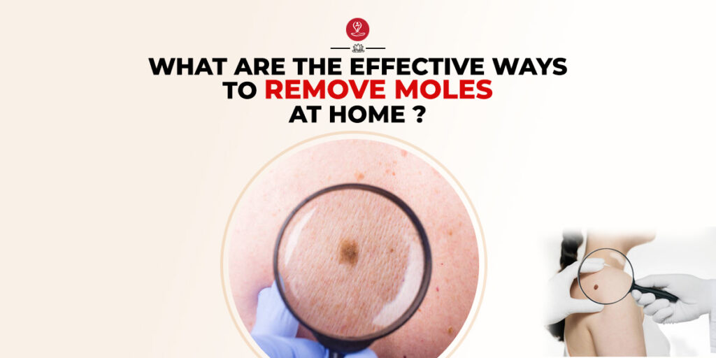 Remove Moles