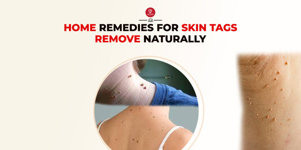 Remedies For Skin Tags