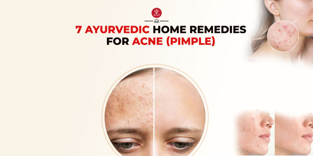 Home Remedies for Acne
