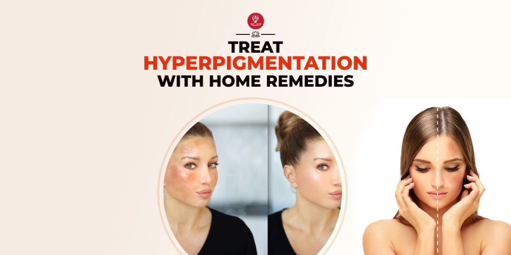 Natural home remedies for hyperpigmentation using milk, licorice extract, and masoor dal to reduce dark spots and uneven skin tone naturally.