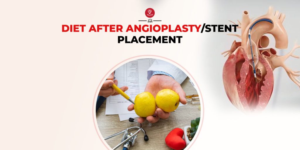 Diet after angioplasty