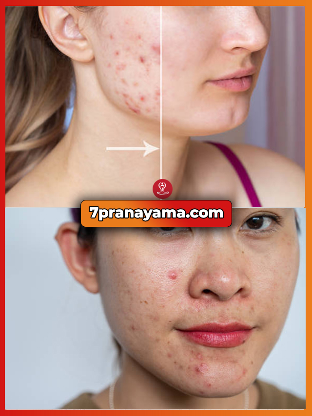 Acne-Relief