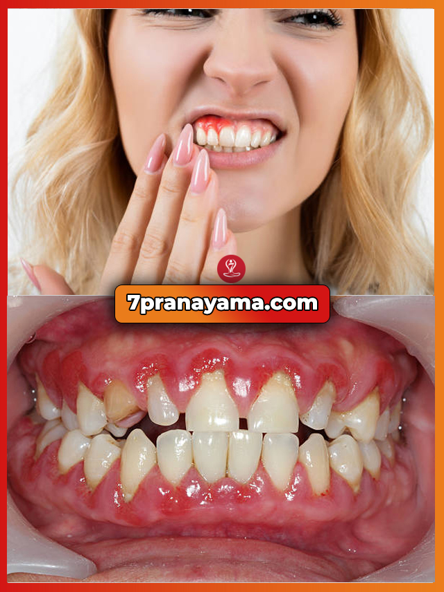 Swollen-Gums-Near-the-Tooth