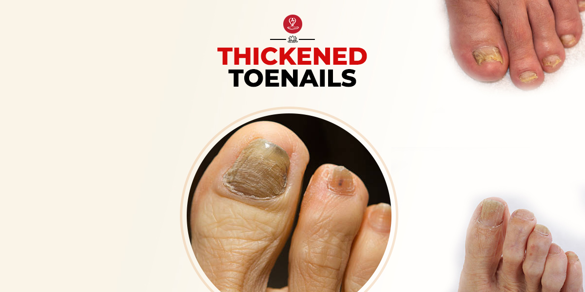 Thickened Toenails